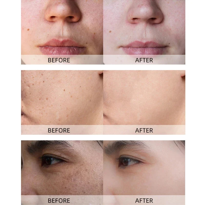 Turmeric lemon Skin Care products Acne Dark Spot Remover…