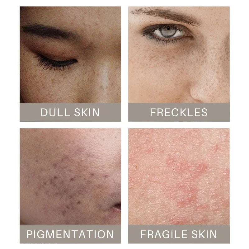 Turmeric lemon Skin Care products Acne Dark Spot Remover…