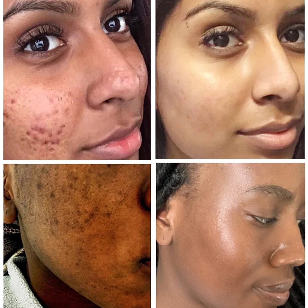 Turmeric lemon Skin Care products Acne Dark Spot Remover…