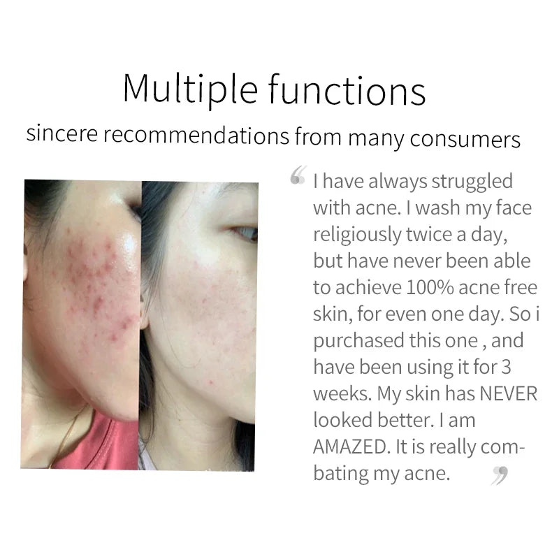 Turmeric lemon Skin Care products Acne Dark Spot Remover…