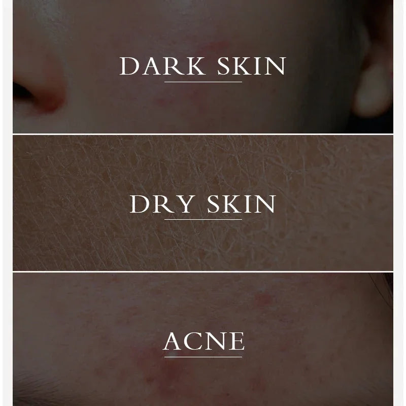 Turmeric lemon Skin Care products Acne Dark Spot Remover…