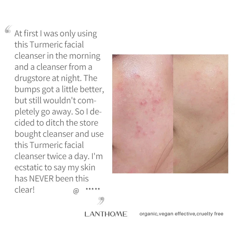 Turmeric lemon Skin Care products Acne Dark Spot Remover…