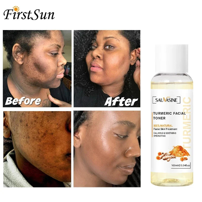 Turmeric lemon Skin Care products Acne Dark Spot Remover…