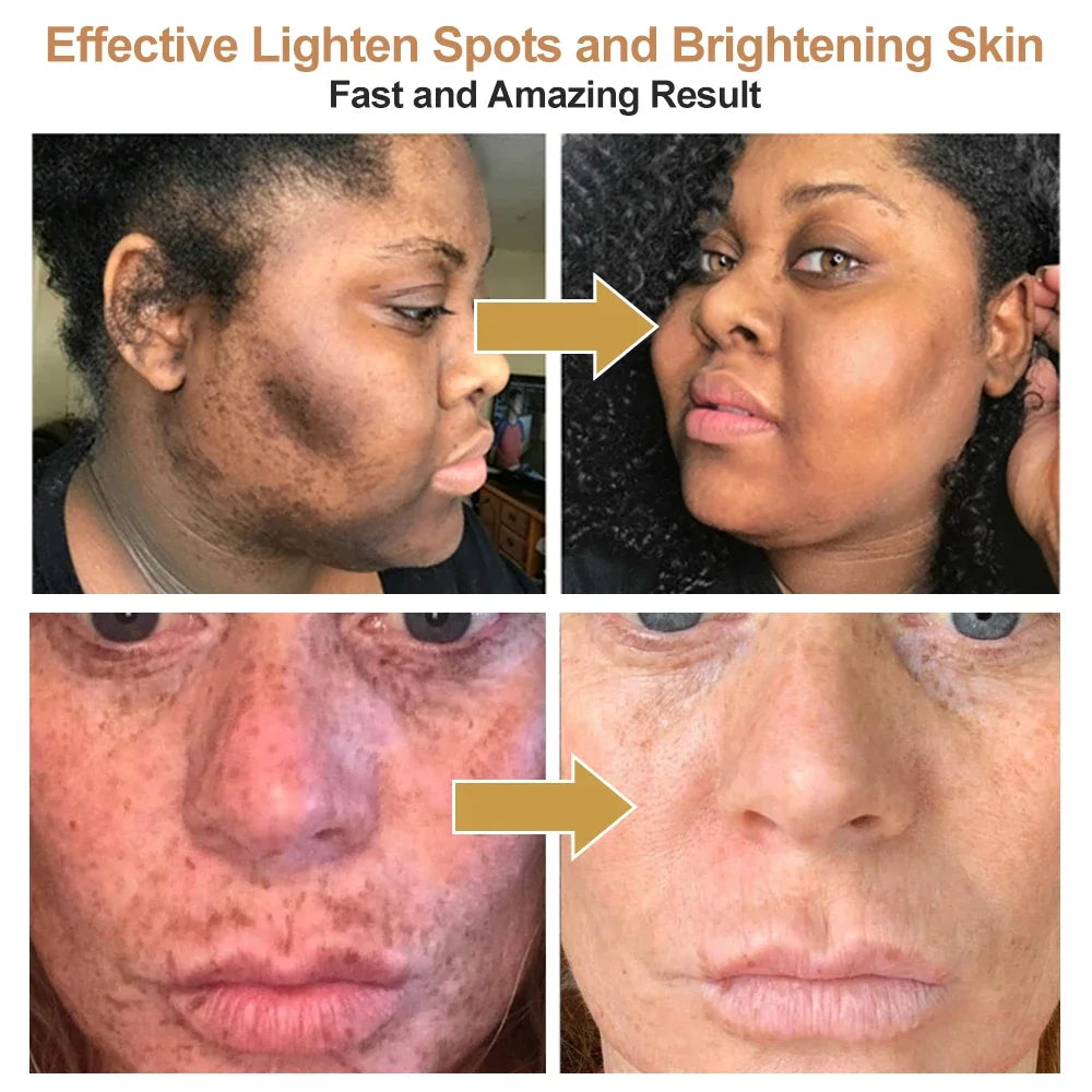 Turmeric lemon Skin Care products Acne Dark Spot Remover…